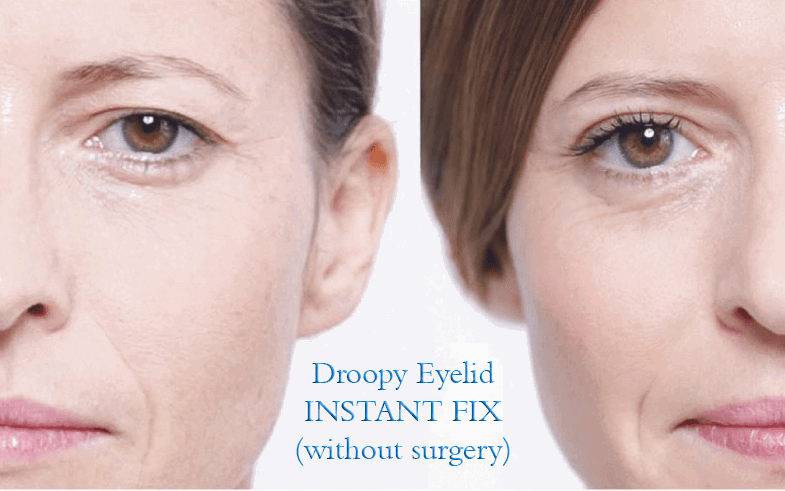 best-droopy-eyelid-fix-no-surgery-eye-secrets-eyelid-lift-yummylooks