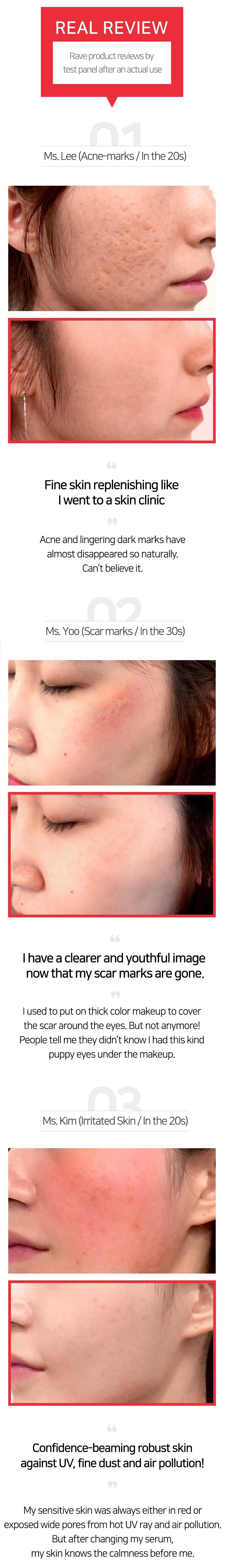 Scar Reviews-(before-and-after)