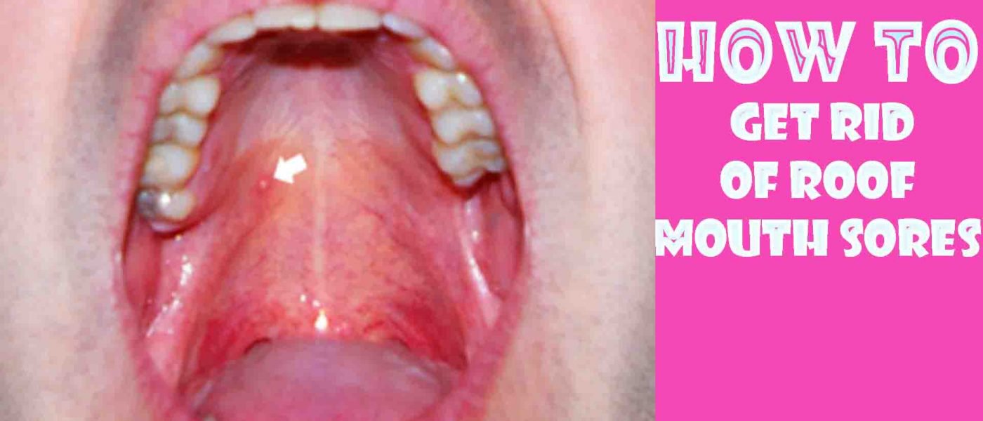 31-home-remedies-to-get-rid-of-mouth-ulcers-mouth-sores-in-2020