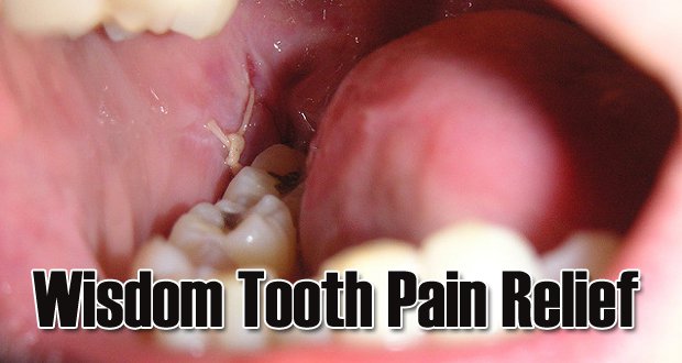 An Unbiased View of Wisdom Teeth Healing